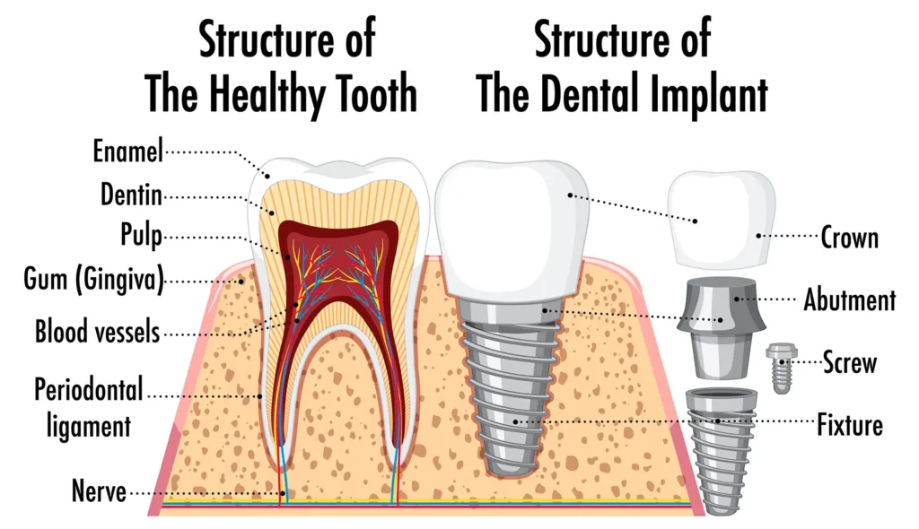 Comparison of the structure of a healthy tooth and a dental implant, illustrating the dental implants procedure step by step, including enamel, dentin, pulp, gum, blood vessels, periodontal ligament, nerve, crown, abutment, screw, and fixture.