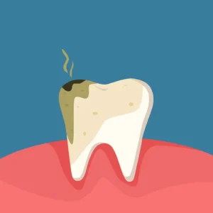 Illustration of a tooth suffering from severe tooth decay, highlighting the importance of oral hygiene for overall health.