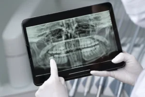 Close-up of a dentist examining an X-ray showing wisdom teeth, highlighting the connection between wisdom teeth and heart health.