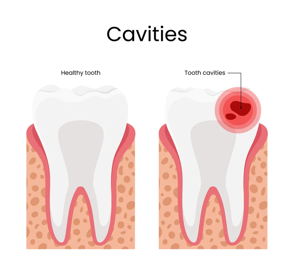 Illustration showing a healthy tooth versus a tooth with cavities, used for educational purposes by Legacy Smiles.